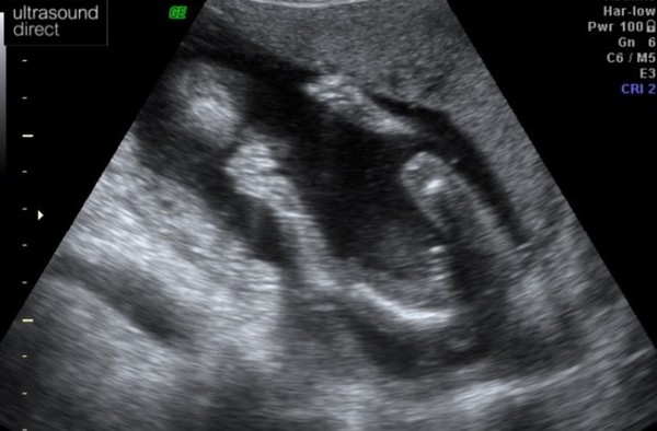 First Scan Picture