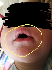 What's this rash?