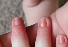 7mo with black lines on nail. Photos..