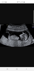 12 week scan, girl or boy?