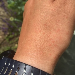 Suddenly allergic to the sun?
