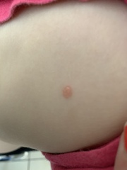 Chicken pox