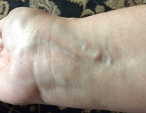 What are these lumps in my wrist?