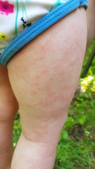 Is this eczema? Or an allergy?