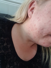 Roaccutane