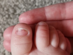 7mo with black lines on nail. Photos..