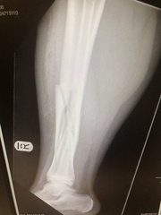 Broken tib/fib