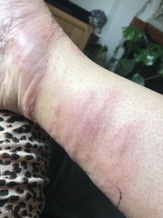 Does this look /sound like shingles? Something else?