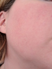 Rosacea advice.
