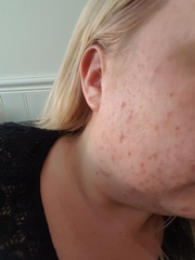 Roaccutane