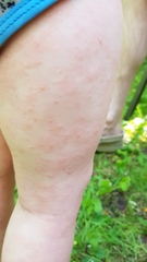 Is this eczema? Or an allergy?