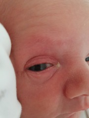 newborn is this conjunctivitis? *pic attached*
