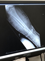 Broken tib/fib