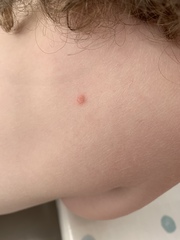 Chicken pox