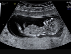 12 week scan, girl or boy?