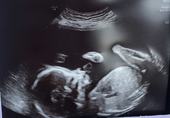 Skull theory guesses from 20 week scan