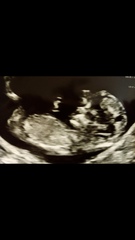12 week gender guess please not sure seeing right nub 😂