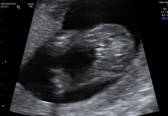 Private gender scan