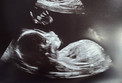 Skull theory guesses from 20 week scan