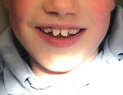 Can I 'add' to my teeth?