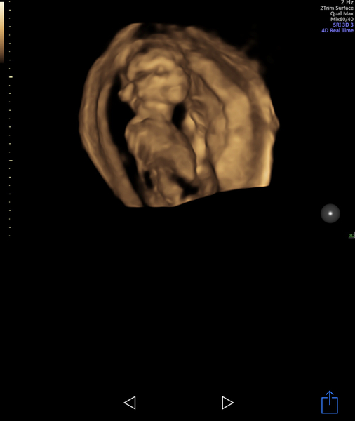 Gender guess! Just for fun until re scan Tuesday!