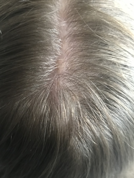 Any ideas what this is on my 9 year olds scalp?- photo
