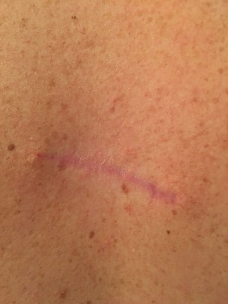 Anyone had a mole investigated?  GP has referred me to hospital.