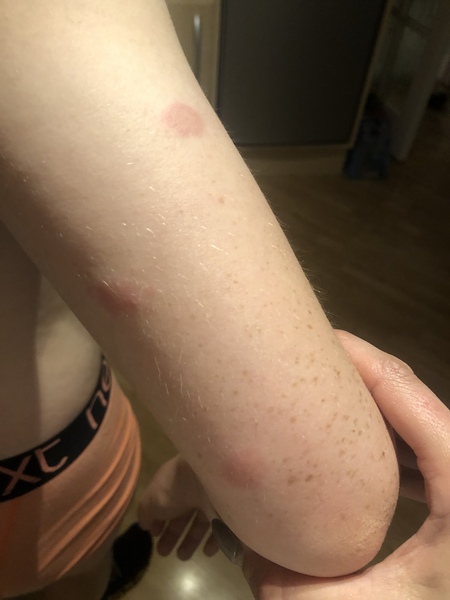 What caused these bites?