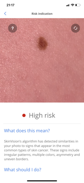 Anyone had a mole investigated?  GP has referred me to hospital.