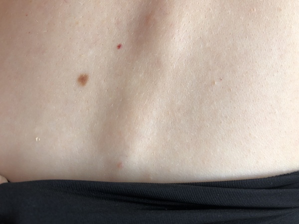 To be in such a state about a mole on my back