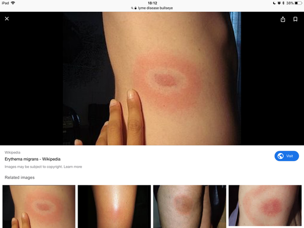 To think this is lymes disease (with pic)