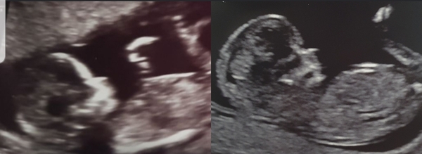 Anyone else had there babies scans look so similar??