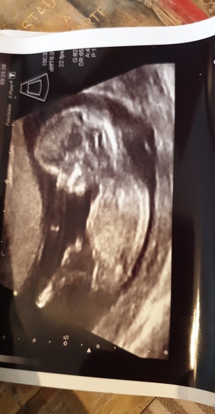 Step on up! 12 week scan photo. What's your guess?!