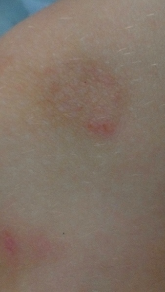 Ringworm or Ezcema?