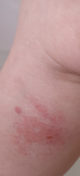 Identify this bite , what bug ?
