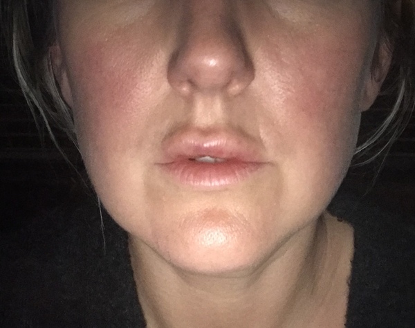 Lip filler