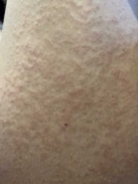 Please help! What is this rash?!