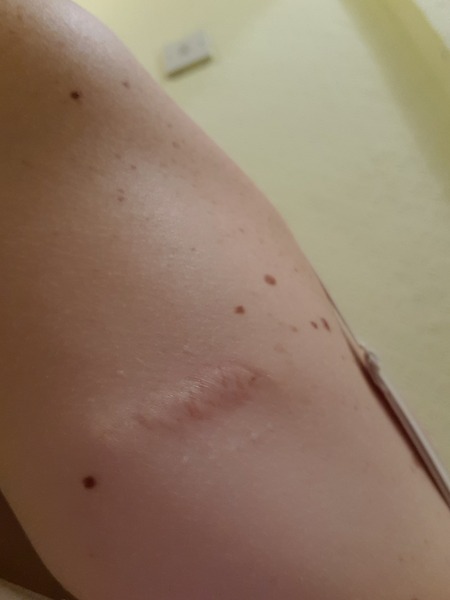 Anyone had a mole investigated?  GP has referred me to hospital.
