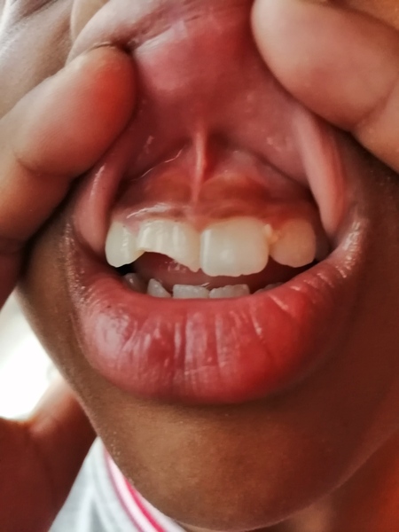 Daughter lost half her tooth. Impact fracture