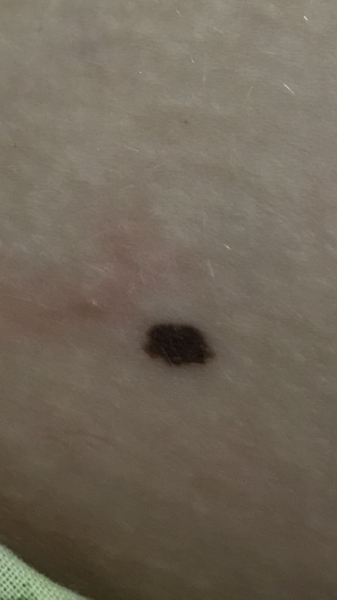 Does this mole look dodgy to you?