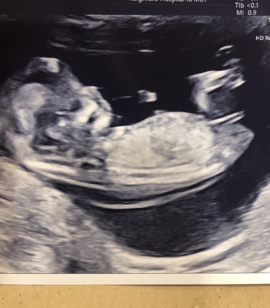 The Graduates of TTC after pregnancy loss thread