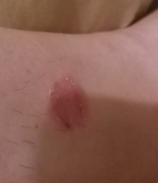 Week-old insect bite