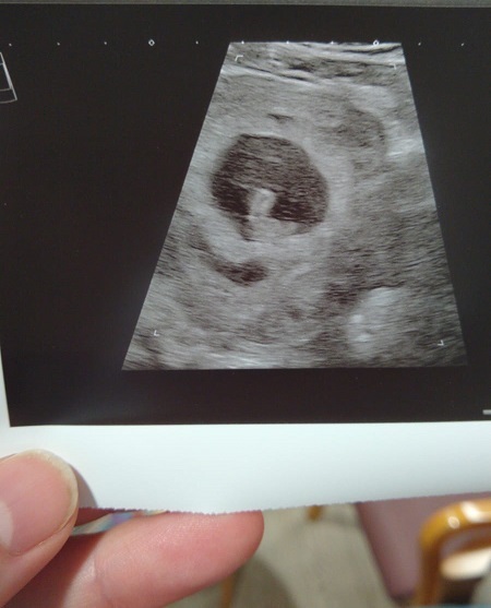 Scan at 7 weeks