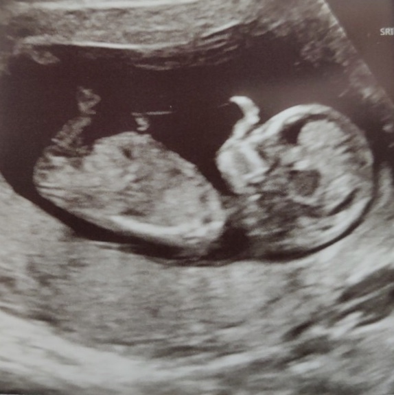 I’m rubbish at nub theory - any guesses from 12 week scan?