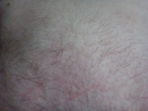 Please, please help me - Hirsutism