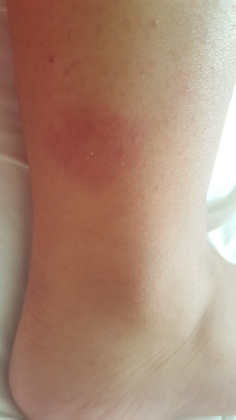 What kind of bite does this look like?