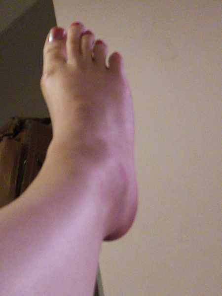 Ankle sprain or fracture?