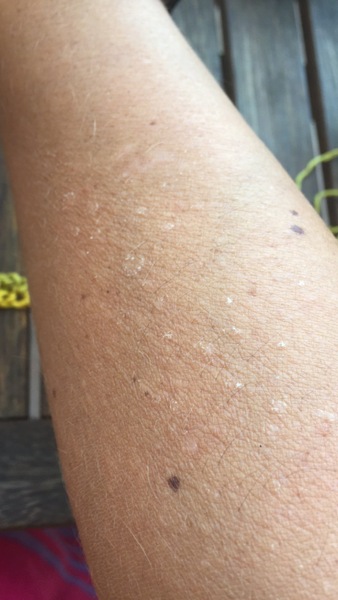 Suddenly allergic to the sun?