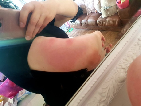 Mosquito bites from Hell....