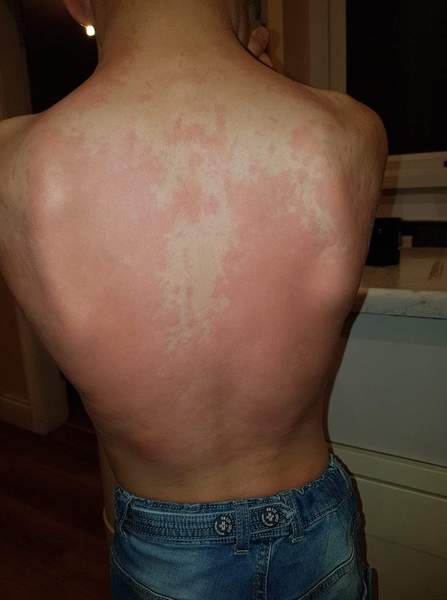 To think this looks like a peanut allergy?